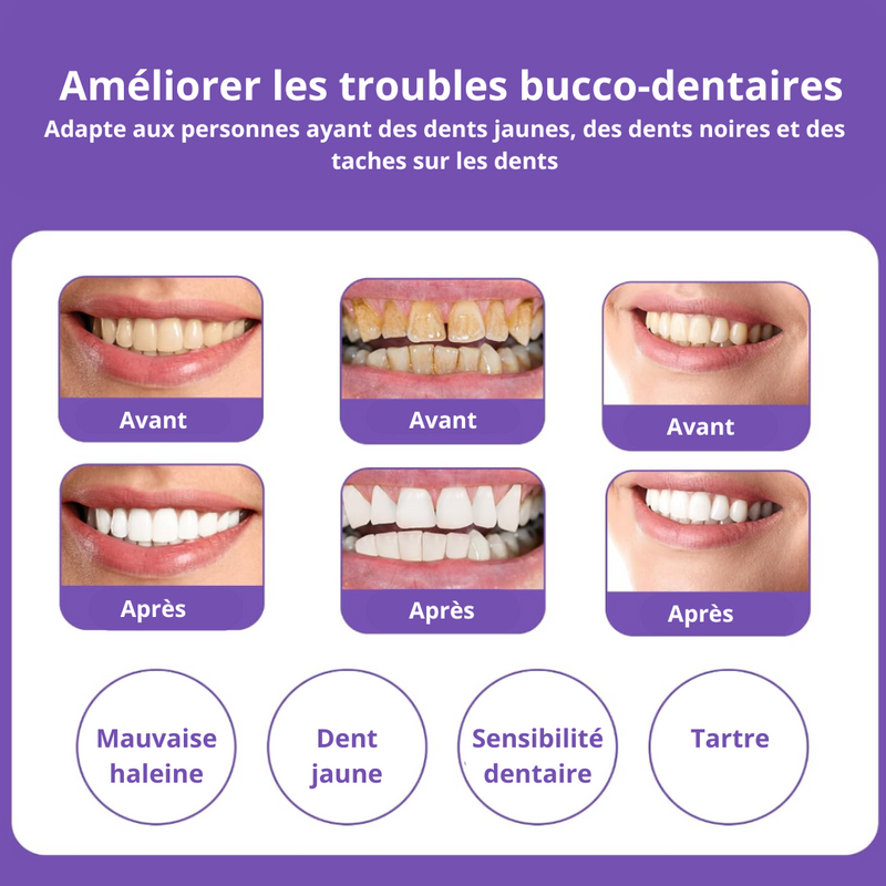 Professional Whitener V34 Smile - Des dents blanches en 7 jours (Dernières unités)